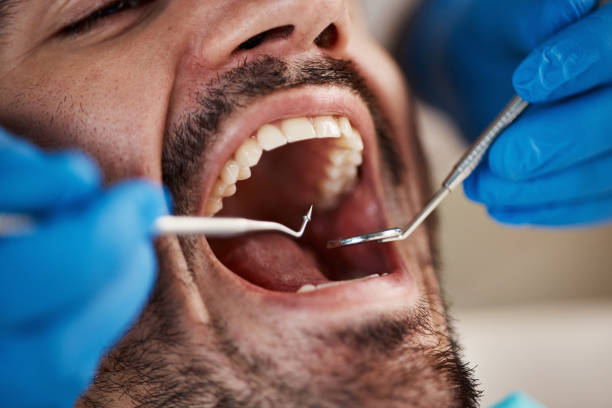 Best Emergency Wisdom Teeth Removal in Applewood, CO