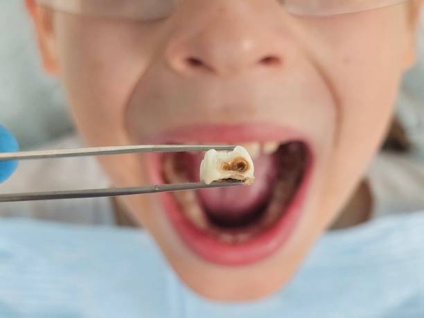 Best Emergency Treatment for Toothache in Applewood, CO